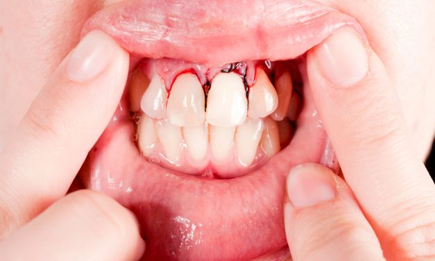 Prevention Of Periodontal Disease