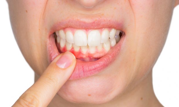 Itchy Gums And Its Causes