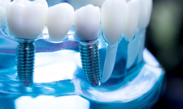 Simplification of Implant Dentistry